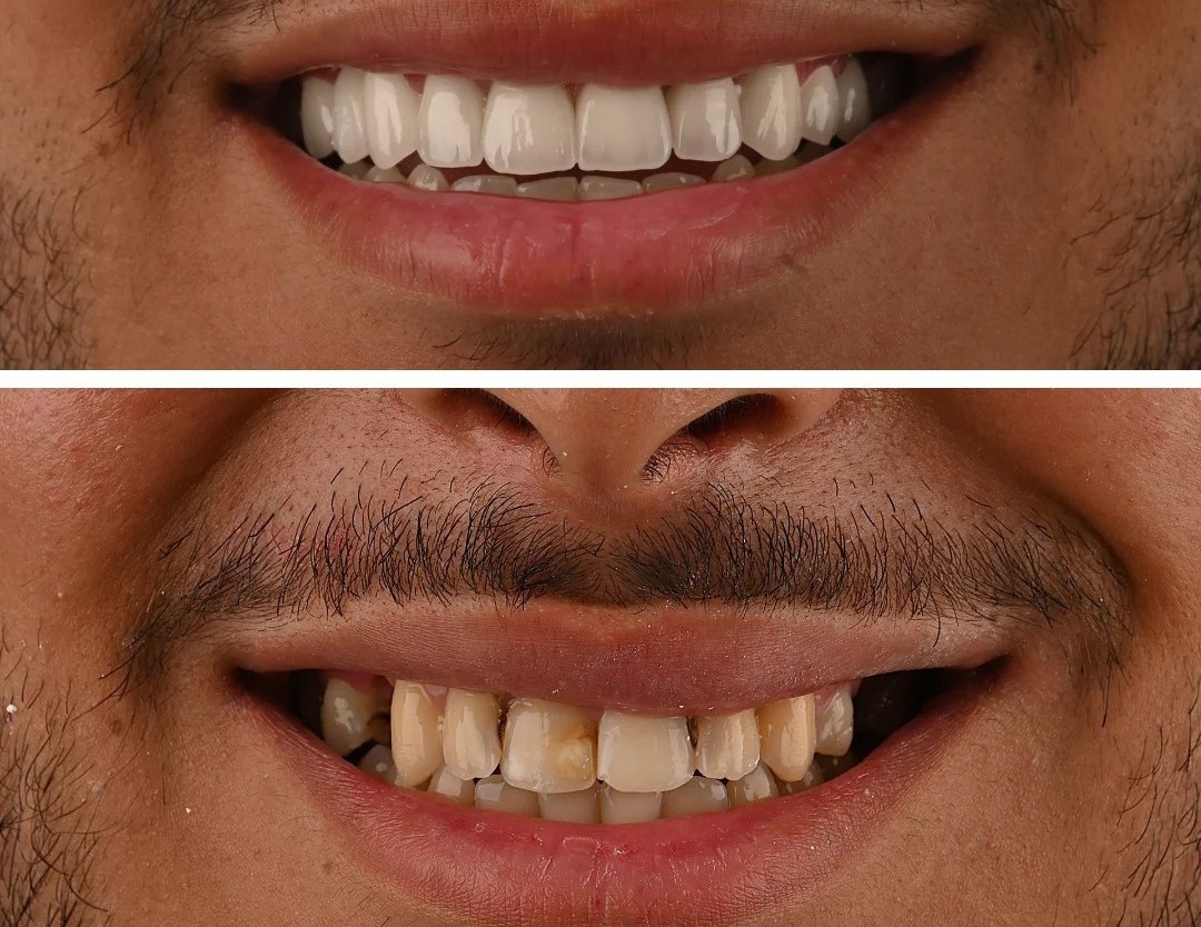 Prix des facettes dentaires au Maroc en 2026 : guide complet